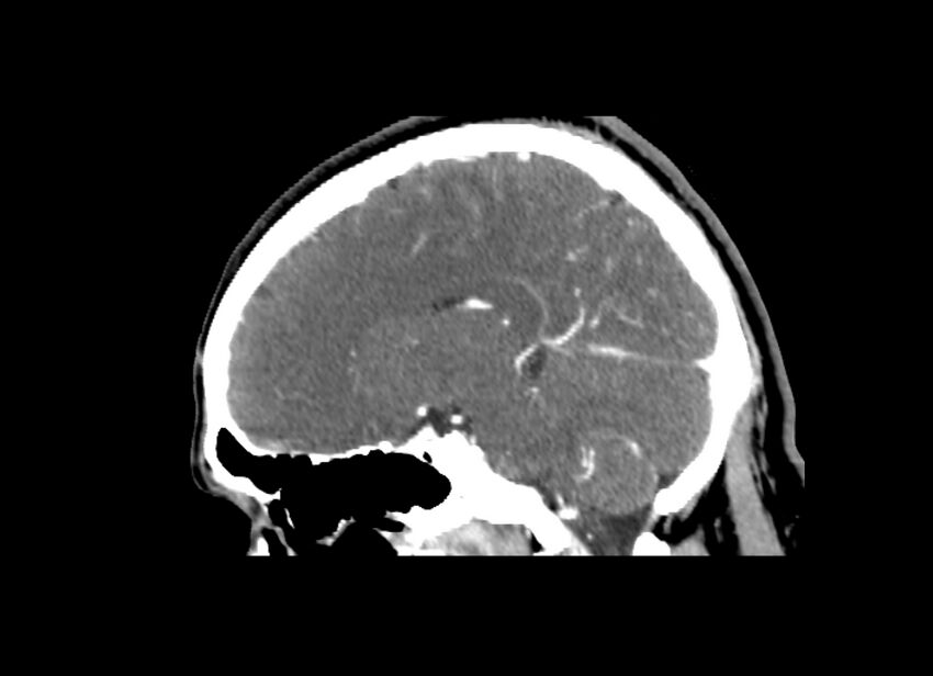 Cerebral edema (Radiopaedia 82519-96661 D 31).jpg