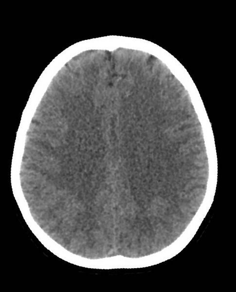 File:Cerebral edema due to severe hyponatremia (Radiopaedia 89826-106938 Axial non-contrast 68).jpg