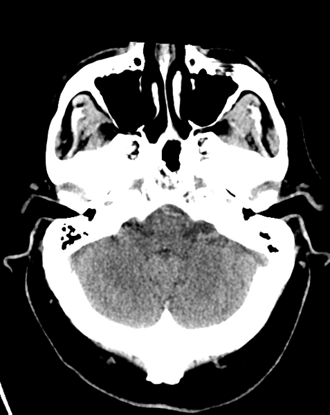 File:Cerebral embolic infarcts (embolic shower) (Radiopaedia 57395-64341 Axial non-contrast 7).png