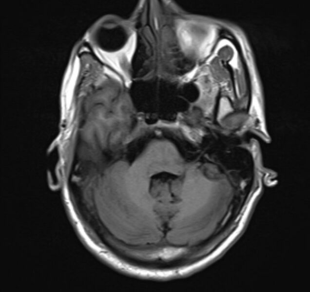 File:Cerebral venous thrombosis (Radiopaedia 71207-81504 Axial T1 7).jpg