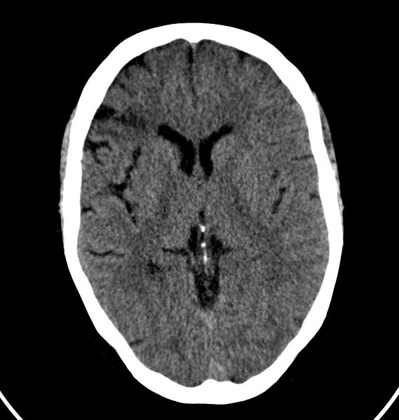 File:Cerebral venous thrombosis - CT only (Radiopaedia 41031-43778 Axial non-contrast 43).jpg