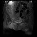 Cervical carcinoma (Radiopaedia 78847-91705 Coronal T2 fat sat 4).jpg