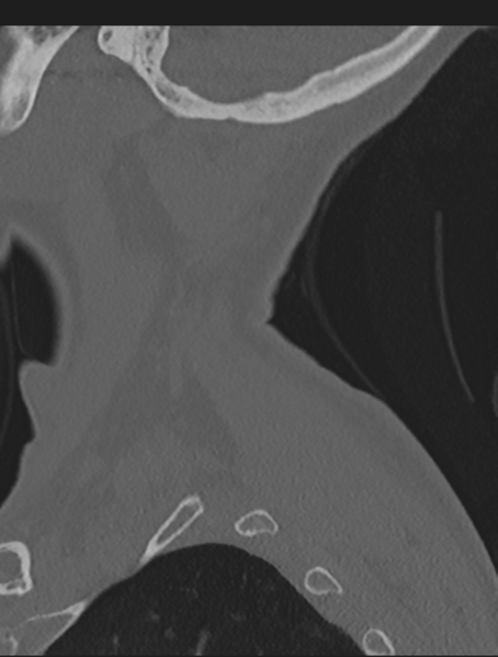 File:Cervical spondylolysis (Radiopaedia 49616-54811 Sagittal bone window 6).png