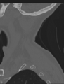 Cervical spondylolysis (Radiopaedia 49616-54811 Sagittal bone window 6).png