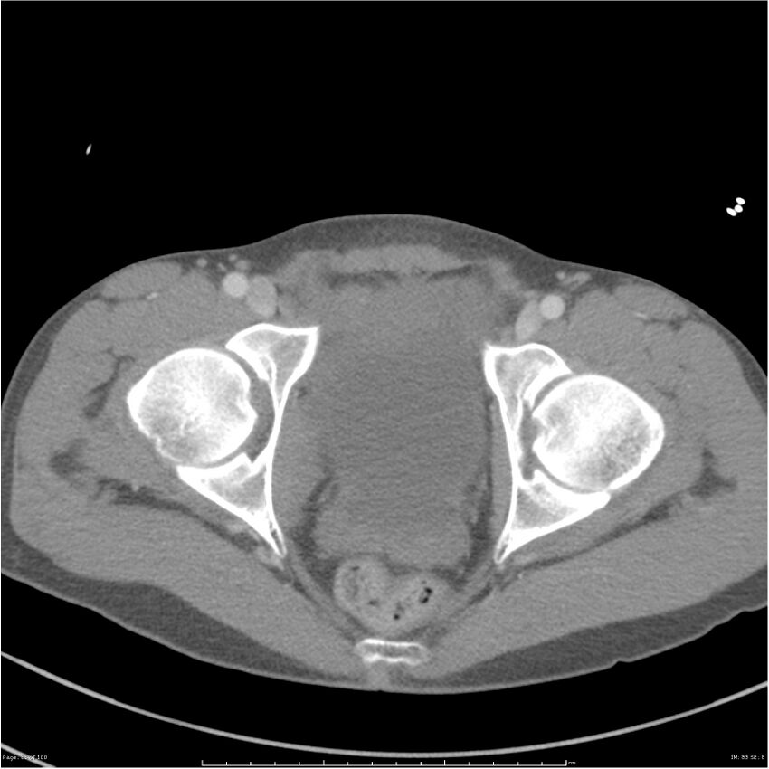 Chest and abdomen multi-trauma (Radiopaedia 26294-26426 A 83).jpg