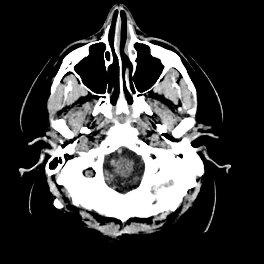 Chiasmatic-hypothalamic juvenile pilocytic astrocytoma (Radiopaedia 78533-91237 Axial non-contrast 10).jpg