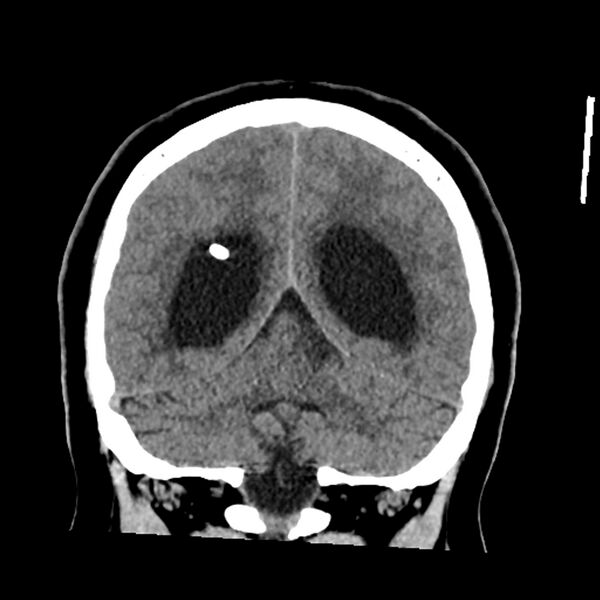 File:Chiasmatic-hypothalamic juvenile pilocytic astrocytoma (Radiopaedia 78533-91237 Coronal non-contrast 50).jpg