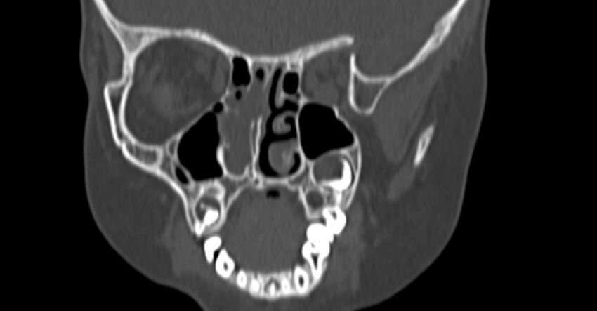 Choanal atresia (Radiopaedia 51295-56972 Coronal bone window 42).jpg
