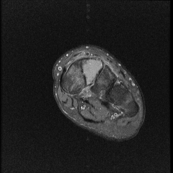 File:Chondroblastoma - midfoot (Radiopaedia 64831-73765 E 15).jpg