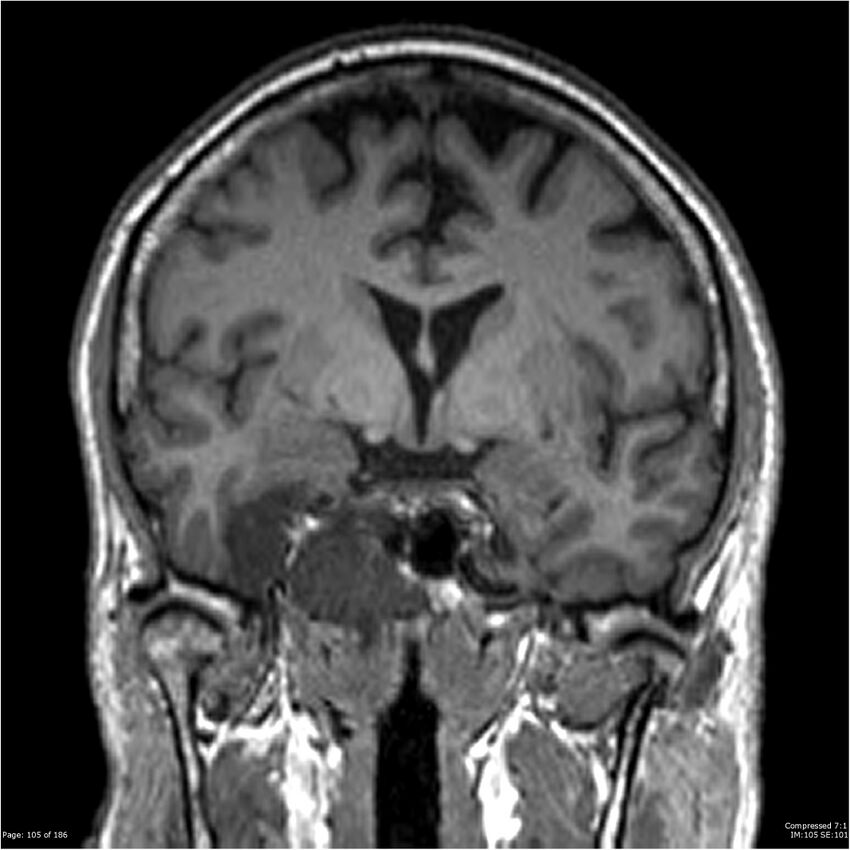 Chondrosarcoma of skull base- grade II (Radiopaedia 40948-43654 Coronal T1 26).jpg