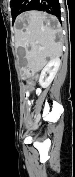 File:Choriocarcinoma liver metastases (Radiopaedia 74768-85766 C 123).jpg