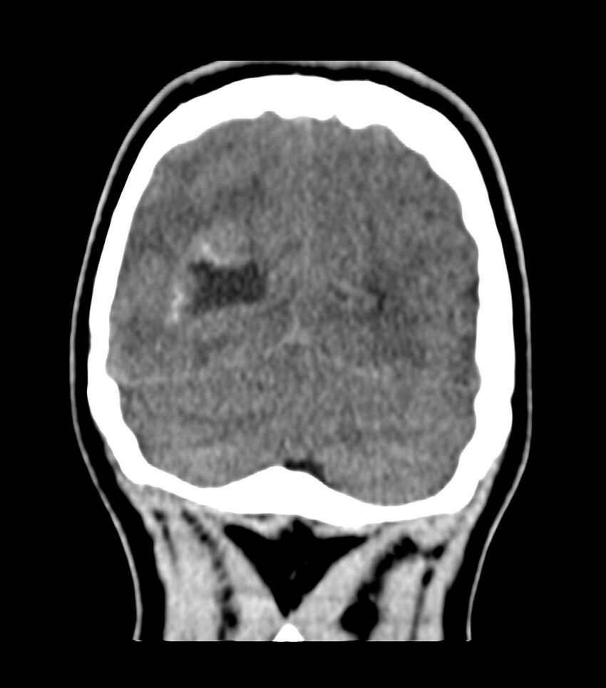 Choroid plexus carcinoma (Radiopaedia 91013-108552 Coronal non-contrast 72).jpg
