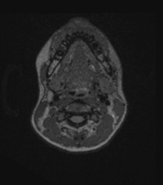 File:Choroid plexus carcinoma (Radiopaedia 91013-108553 Axial FLAIR C+ 27).jpg