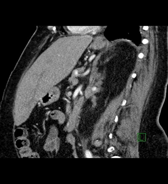 File:Chromophobe renal cell carcinoma (Radiopaedia 84239-99519 D 54).jpg