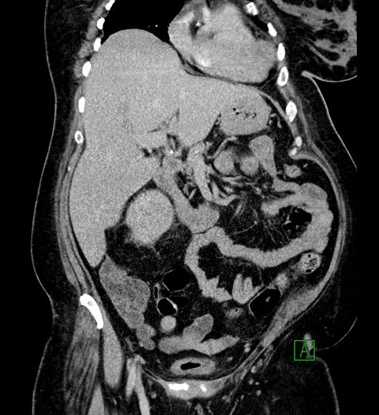 File:Chromophobe renal cell carcinoma (Radiopaedia 84239-99519 F 36).jpg