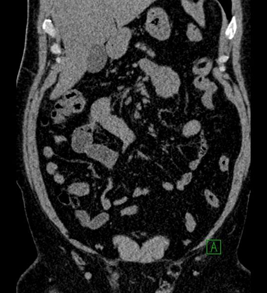 File:Chromophobe renal cell carcinoma (Radiopaedia 84286-99573 Coronal non-contrast 53).jpg