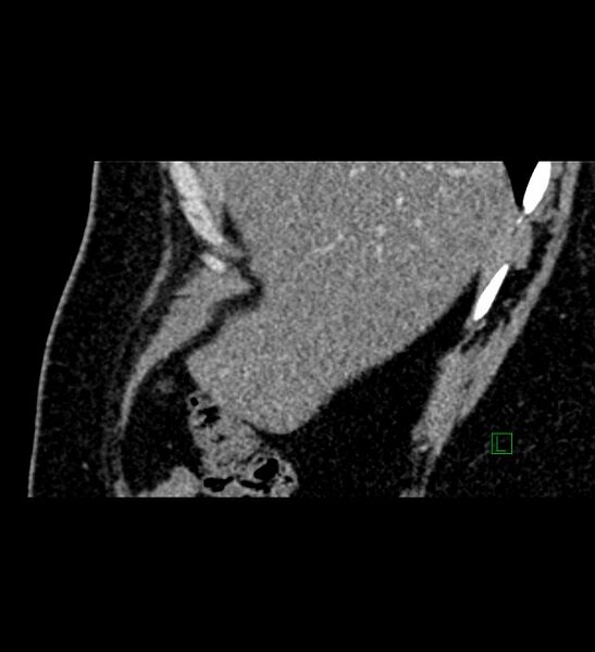 File:Chromophobe renal cell carcinoma (Radiopaedia 84286-99573 F 155).jpg
