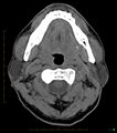 Chronic Submandibular sialolithiasis (Radiopaedia 16880-16606 Axial non-contrast 11).jpg