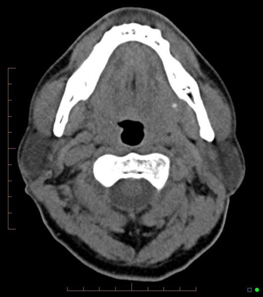 File:Chronic Submandibular sialolithiasis (Radiopaedia 16880-16606 Axial non-contrast 11).jpg