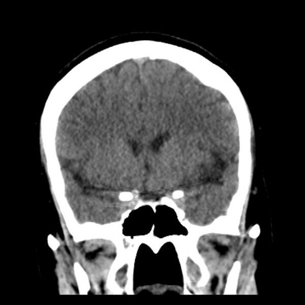 File:Chronic bilateral occipital lobe infarcts (Radiopaedia 31276-31996 Coronal non-contrast 19).jpg