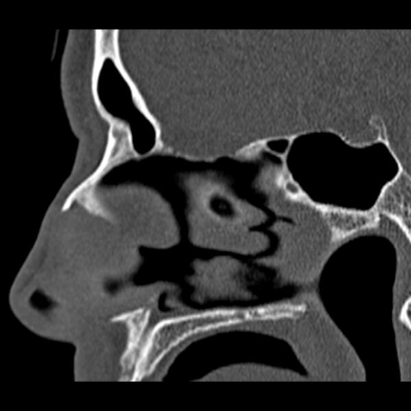 File:Chronic maxillary sinusitis (Radiopaedia 27879-28116 Sagittal bone window 26).jpg