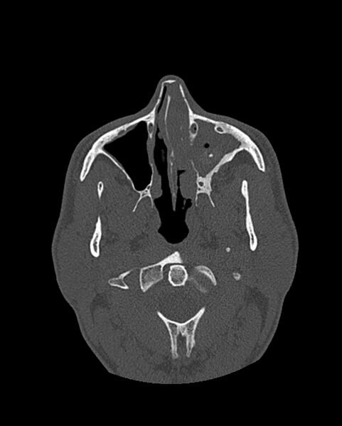 File:Chronic maxillary sinusitis caused by a foreign body (Radiopaedia 58521-65676 Axial bone window 121).jpg