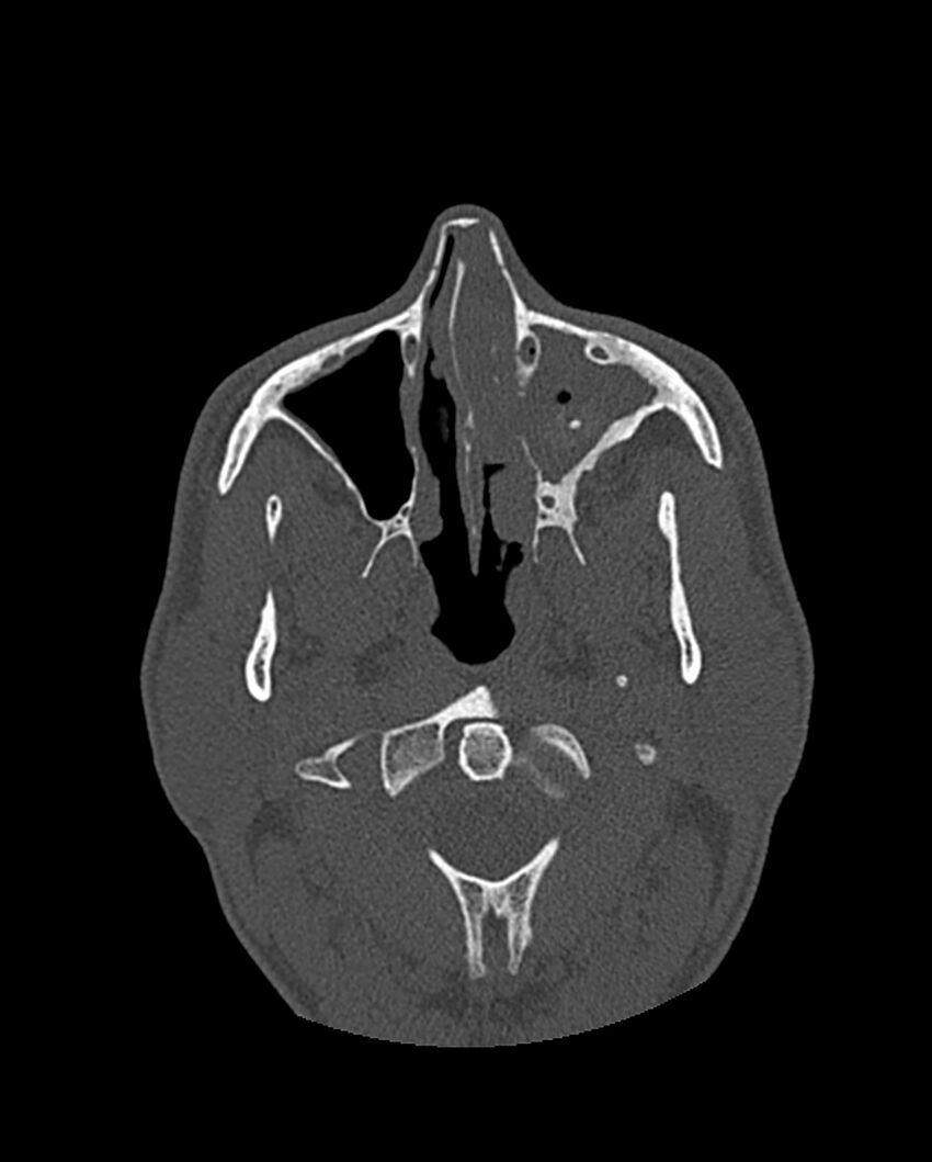 Chronic maxillary sinusitis caused by a foreign body (Radiopaedia 58521-65676 Axial bone window 121).jpg