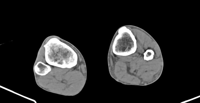 Chronic osteomyelitis (with sequestrum) (Radiopaedia 74813-85822 D 208).jpg