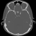 Chronic otomastoiditis (Radiopaedia 27138-27309 Axial bone window 51).jpg