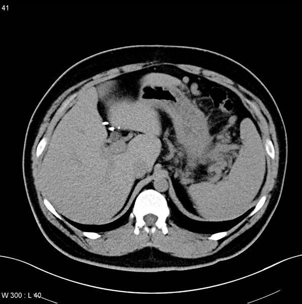 File:Chronic pancreatitis and pseudocysts (Radiopaedia 6724-7935 Axial non-contrast 1).jpg