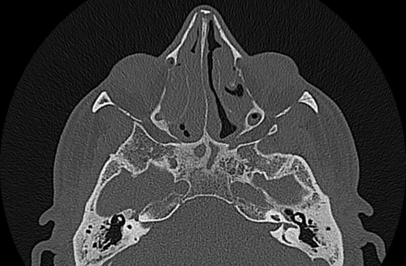File:Chronic rhinosinusitis (Radiopaedia 65079-74075 Axial bone window 42).jpg