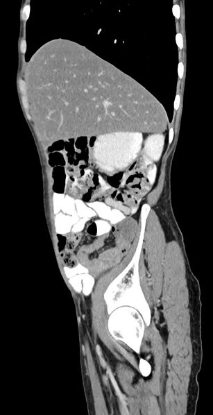 File:Chronic small bowel volvulus (Radiopaedia 75224-86322 C 114).jpg