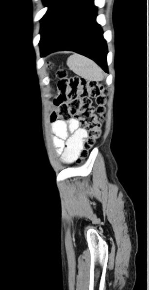 File:Chronic small bowel volvulus (Radiopaedia 75224-86322 C 23).jpg