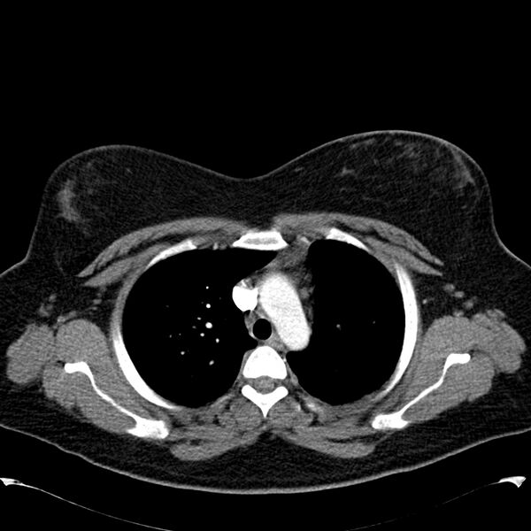 File:Chronic thromboembolic pulmonary hypertension (CTEPH) (Radiopaedia 74597-85531 Axial C+ CTPA 15).jpg