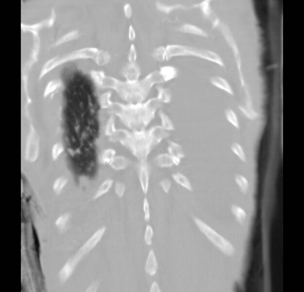 File:Clagett thoracotomy with bronchopleural fistula (Radiopaedia 29192-29587 Coronal lung window 1).jpg