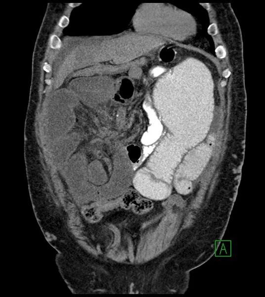 File:Closed-loop small bowel obstruction-internal hernia (Radiopaedia 78439-91096 Coronal non-contrast 31).jpg