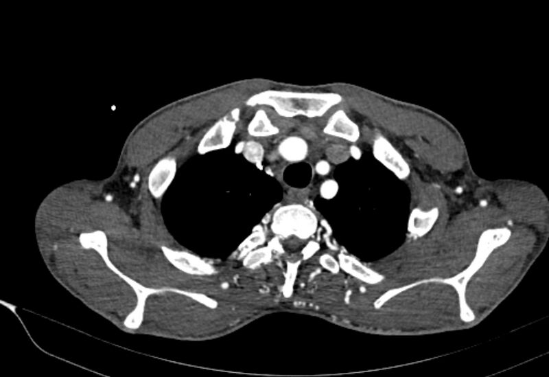 File:Coarctation of aorta with aortic valve stenosis (Radiopaedia 70463-80574 A 3).jpg