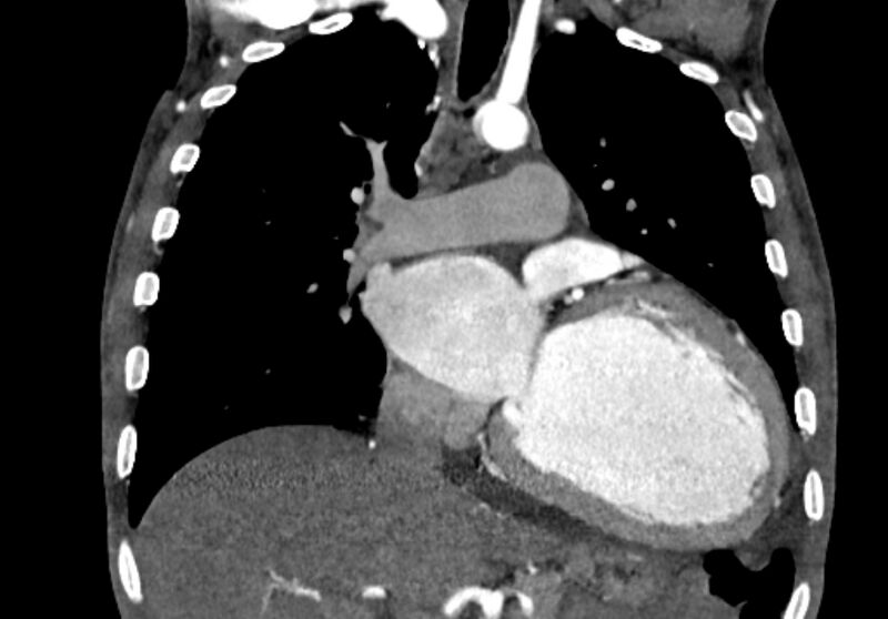 File:Coarctation of aorta with aortic valve stenosis (Radiopaedia 70463-80574 C 105).jpg
