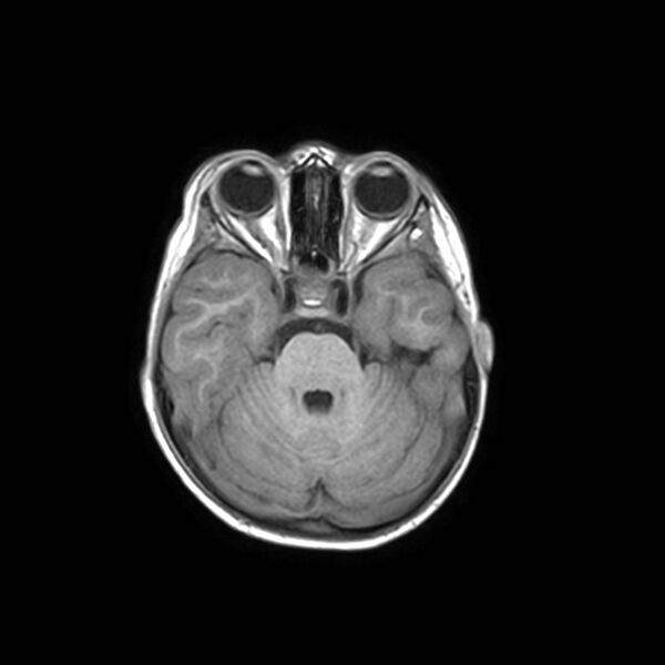 File:Cochlear nerve aplasia - unilateral (Radiopaedia 87910-104413 Axial T1 13).jpg