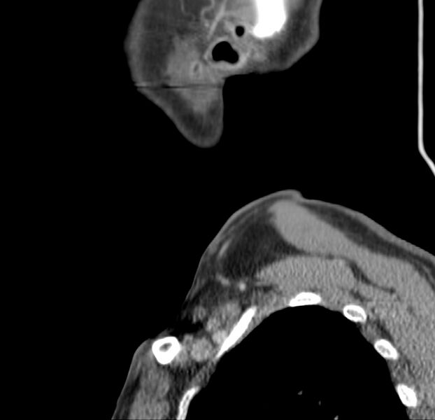 File:Colloid cyst of thyroid (Radiopaedia 22897-22923 Sagittal C+ delayed 7).jpg