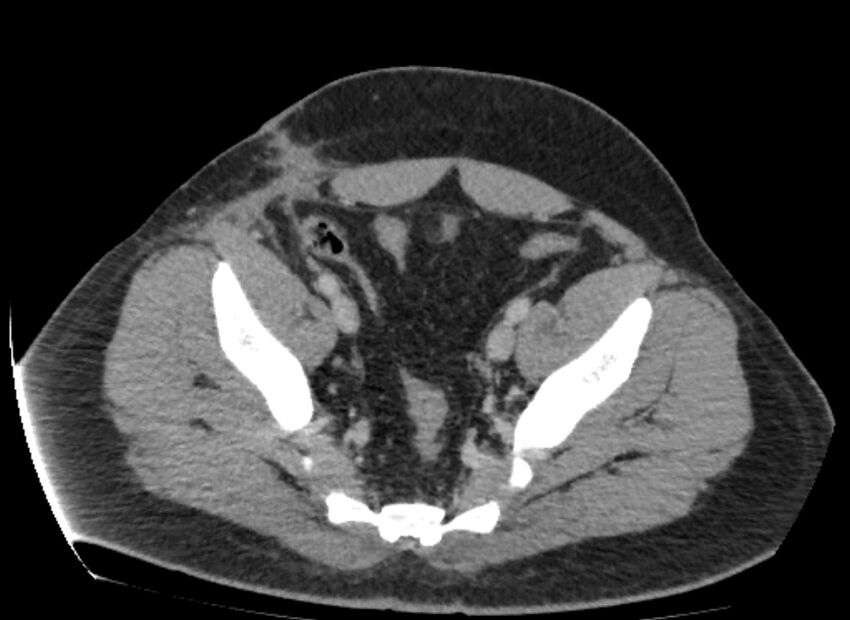 Colocutaneous fistula (Radiopaedia 56401-63062 A 80).jpg
