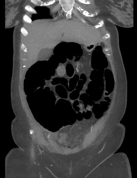 File:Colonic pseudo-obstruction (Radiopaedia 79752-92980 B 21).png