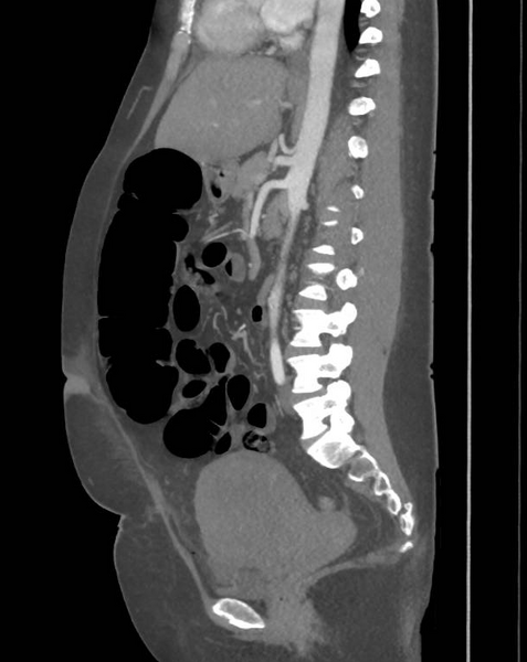 File:Colonic pseudo-obstruction (Radiopaedia 79752-92980 C 43).png