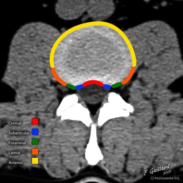 File:Disc herniation nomenclature - axial (annotated image) (Radiopaedia 36344).jpg