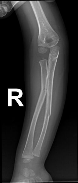 File:Greenstick fractures - radius and ulna (Radiopaedia 84761).jpg