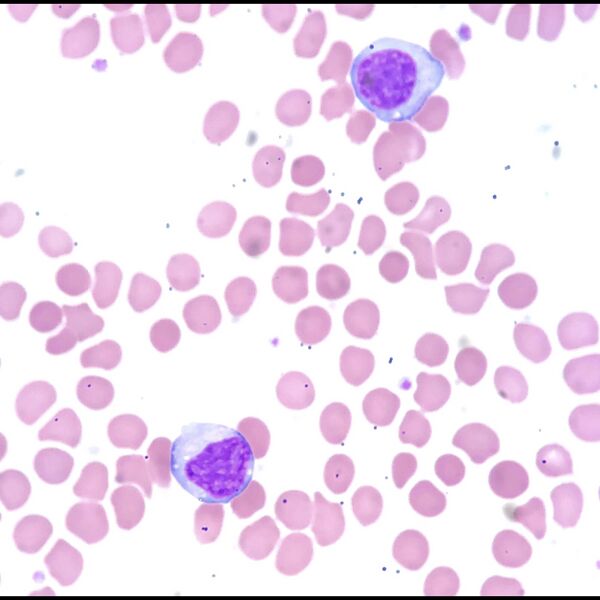 File:Mononucleosis (cytology) (Radiopaedia 78399).jpeg