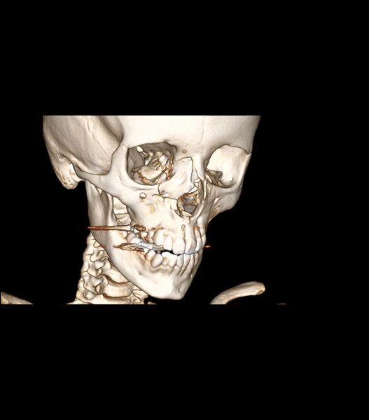 File:Nasoorbitoethmoid fracture (Radiopaedia 90044-107205 3D VRT 13).jpg