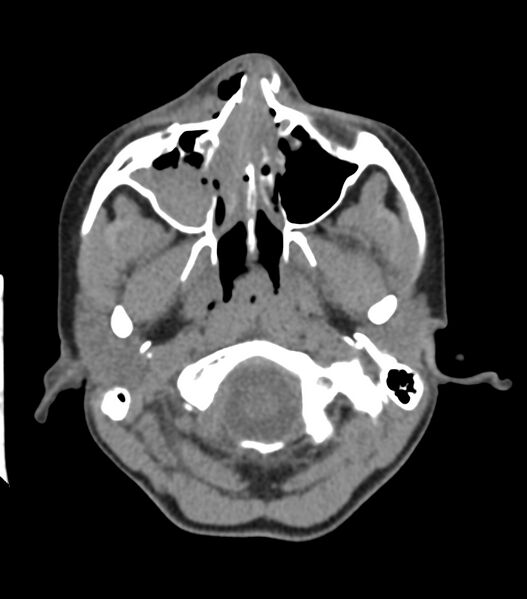 File:Nasoorbitoethmoid fracture (Radiopaedia 90044-107205 Axial non-contrast 131).jpg
