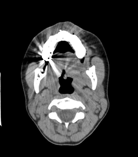 File:Nasoorbitoethmoid fracture (Radiopaedia 90044-107205 Axial non-contrast 87).jpg