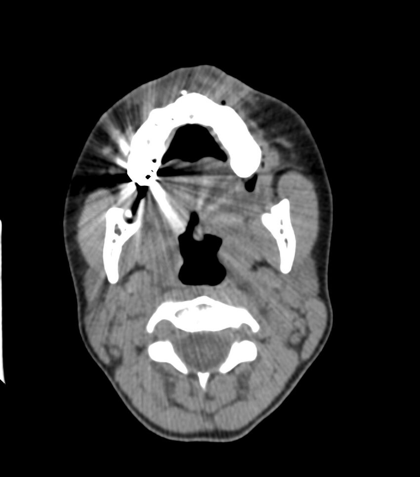 Nasoorbitoethmoid fracture (Radiopaedia 90044-107205 Axial non-contrast 87).jpg
